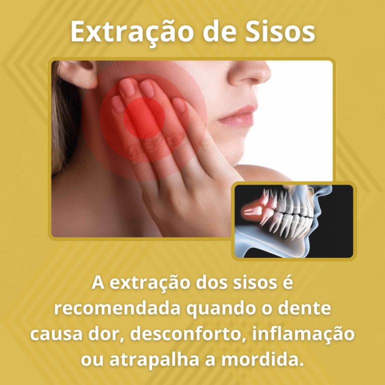 Facetas de Resina